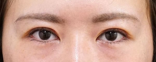 まつ毛側たるみとり　１週間後のAfterの写真