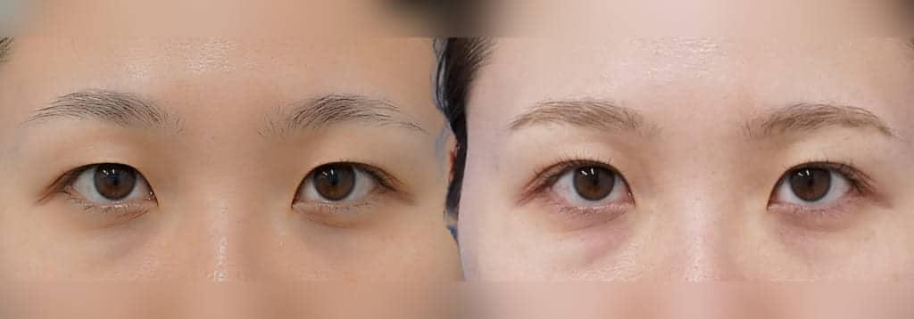 「ナチュラルに変わりたい」を叶える、埋没の魅力