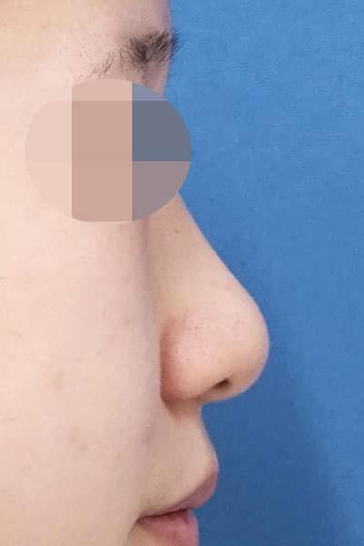 鼻尖縮小、軟骨移植、ストラット　１ヶ月後　右側面のBefore写真