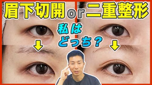 眉下切開と二重全切開の効果と適応とリスクを徹底解説！症例写真もご紹介