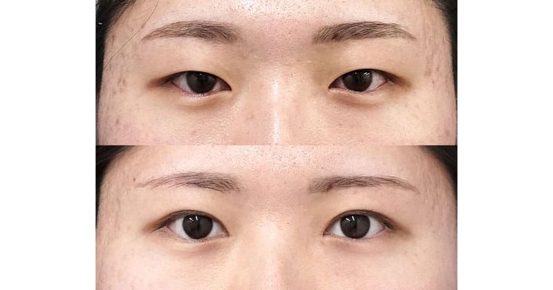 二重術の前に眉下切開で整える。眉下切開、目頭切開Z形成Park法、二重埋没法（もとびアイゴールド）　半年後