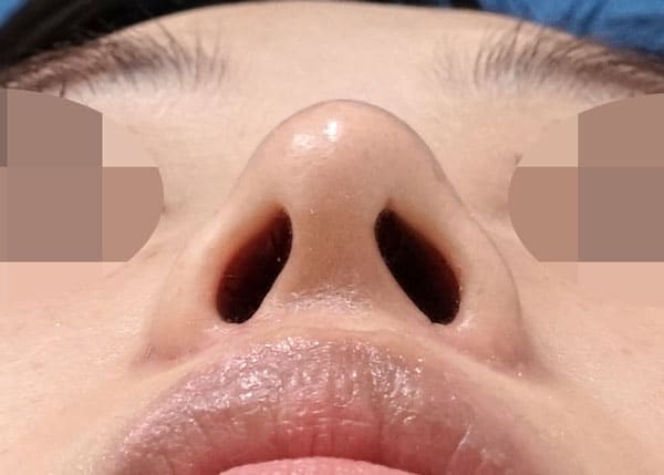 鼻尖縮小+軟骨移植+ストラット、小鼻縮小（内側＋外側）３ヶ月後　下からのAfterの写真