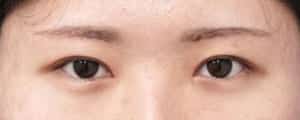 眉下切開、目頭切開Z形成Park法、二重埋没法（もとびアイゴールド）　３ヶ月後