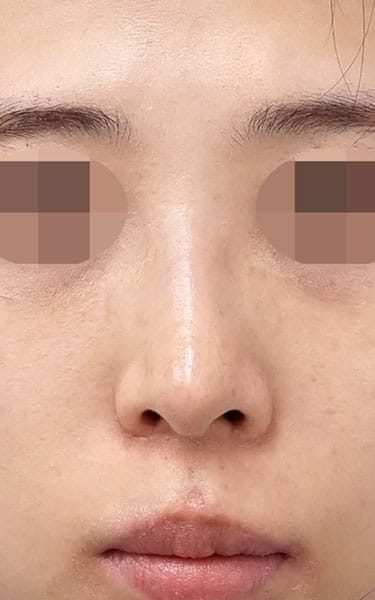鼻尖縮小＋軟骨移植＋ストラット、鼻翼縮小（内＋外）　３ヶ月後　正面のAfterの写真
