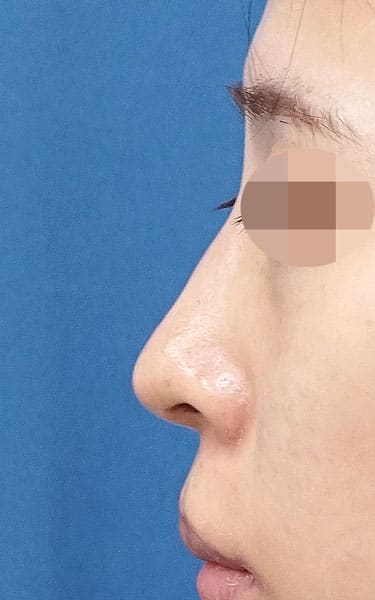 鼻尖縮小＋軟骨移植＋ストラット、鼻翼縮小（内＋外）　３ヶ月後　左側面のAfterの写真