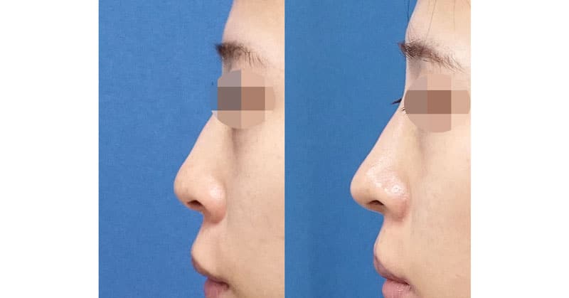 鼻先と鼻の穴をすっきりと整える。鼻尖縮小＋軟骨移植＋ストラット、鼻翼縮小（内＋外）　３ヶ月後