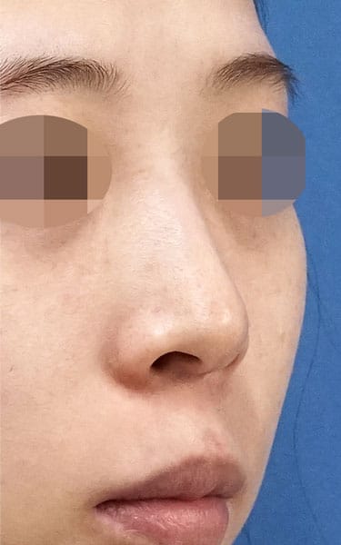 鼻尖縮小＋軟骨移植＋ストラット、鼻翼縮小（内＋外）　３ヶ月後　右斜めのBefore写真