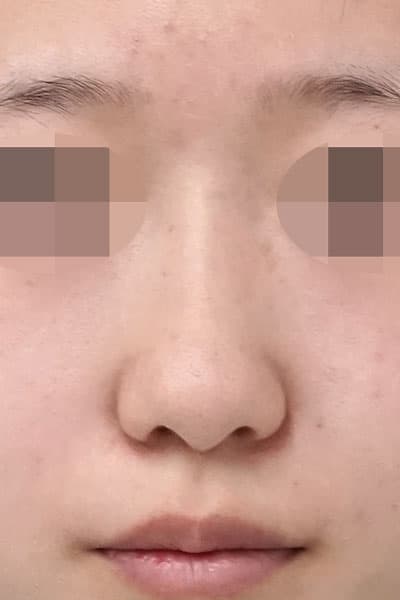 鼻尖縮小、軟骨移植、ストラット 1ヶ月後 正面のBefore写真