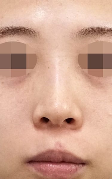 鼻尖縮小＋軟骨移植＋ストラット、鼻翼縮小（内＋外）　３ヶ月後　正面のBefore写真