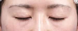 ハム目改善（睫毛側たるみ取り）手術前閉眼