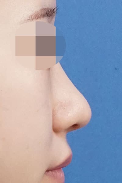 鼻尖縮小、軟骨移植、ストラット　１ヶ月後　右側面のAfterの写真
