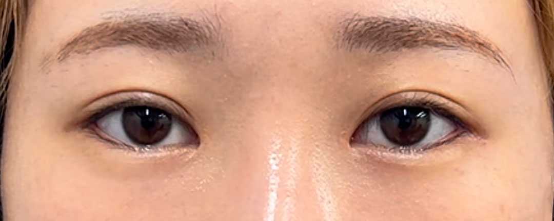 目頭切開Z形成、目尻切開、二重埋没法（もとびアイライト）　6ヶ月後　正面のAfterの写真