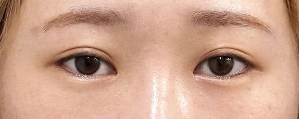 目頭切開Z形成、目尻切開、二重埋没法(もとびアイライト) 6ヶ月後 正面のAfterの写真