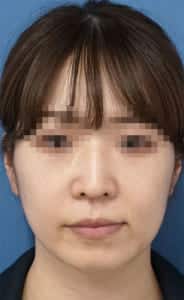 ほうれい線①1週間後サイズ修正