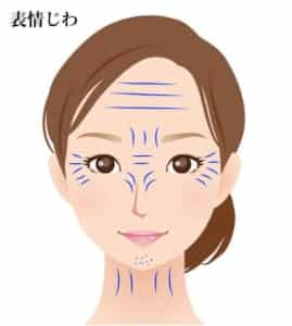 表情じわ