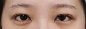 症例写真⑬ 手術前