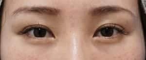 切らないたれ目手術前