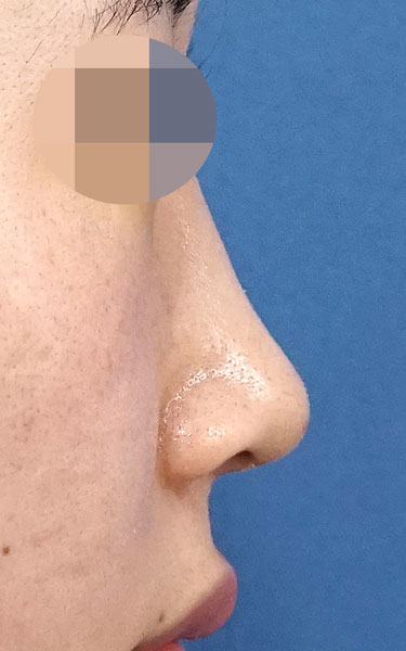 ミスコ（切らない鼻尖延長）　１週間後　右側面のAfterの写真