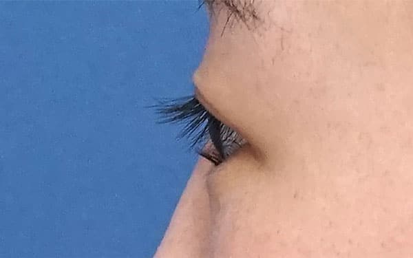目頭切開Z形成、目尻切開、二重埋没法（もとびアイライト）　6ヶ月後　左側面のBefore写真