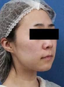症例2 処置前 右斜