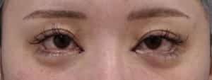 手術直後