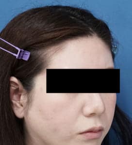 額ヒアルロン酸② 右斜め 処置前