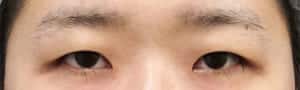 症例写真⑥手術前