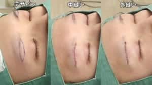 眉下中縫い
