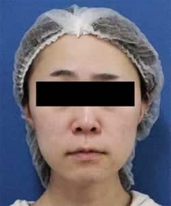 症例2 処置前 正面