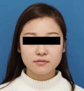 ⑩正面強力小顔