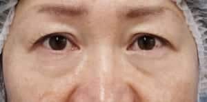 ハムラ法術前