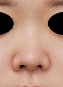鼻柱基部下降③正面術後
