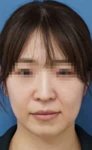 ほうれい線①処置前サイズ修正