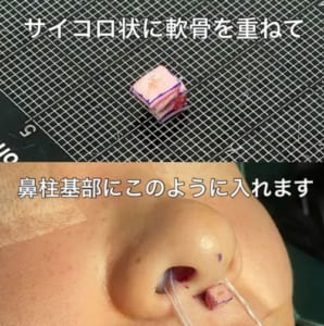 鼻柱基部下降の軟骨