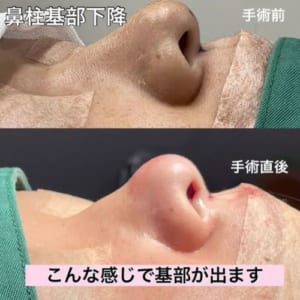 鼻柱基部下降術中変化右側面