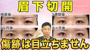 【眉下切開】術後の傷跡を目立たなくするために重要なこと【術者の技量と過ごし方】