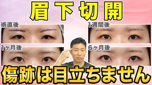 【眉下切開】術後の傷跡を目立たなくするために重要なこと【術者の技量と過ごし方】