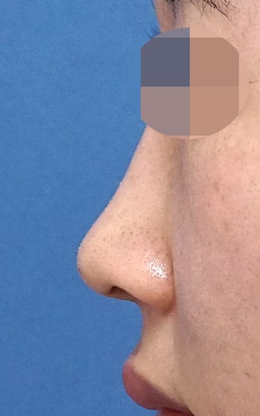 ミスコ(切らない鼻尖延長) 1週間後 左側面のAfterの写真