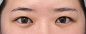 ②術前