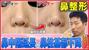 【鼻整形】鼻中隔延長と鼻柱基部下降を比較解説【美容整形】