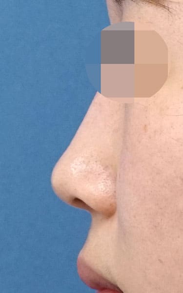 ミスコ（切らない鼻尖延長）　１か月後　左側面のAfterの写真