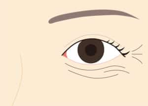目の下、目周りの小じわ