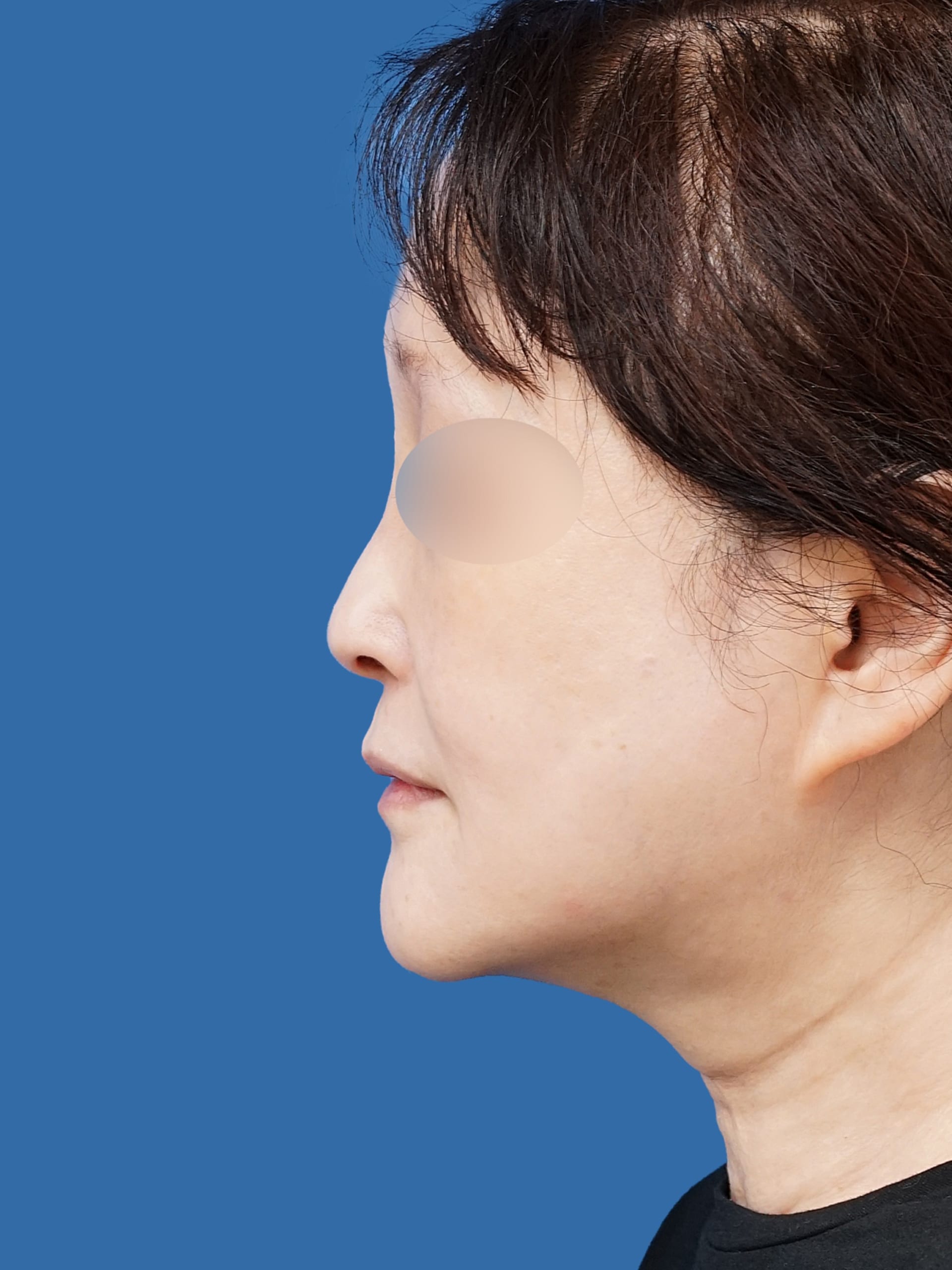 VOVコグリフト 側面 術前vs術後3か月のBefore写真