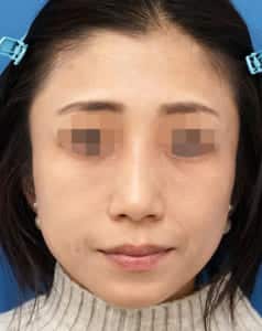 ゴルゴ線・目の下ほうれい線 1週間後