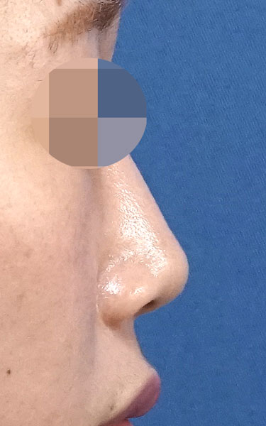 ミスコ（切らない鼻尖延長）　６ヶ月後　右側面のAfterの写真