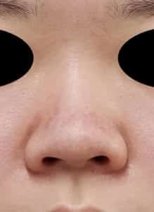 鼻柱基部下降③正面