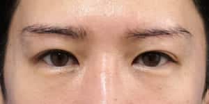 症例写真④6ヶ月後