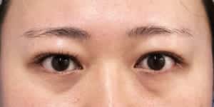 症例写真① 手術前