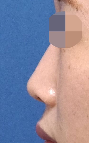 ミスコ（切らない鼻尖延長）　６ヶ月後　左側面のAfterの写真