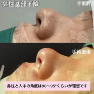 鼻柱基部下降術中変化左側面